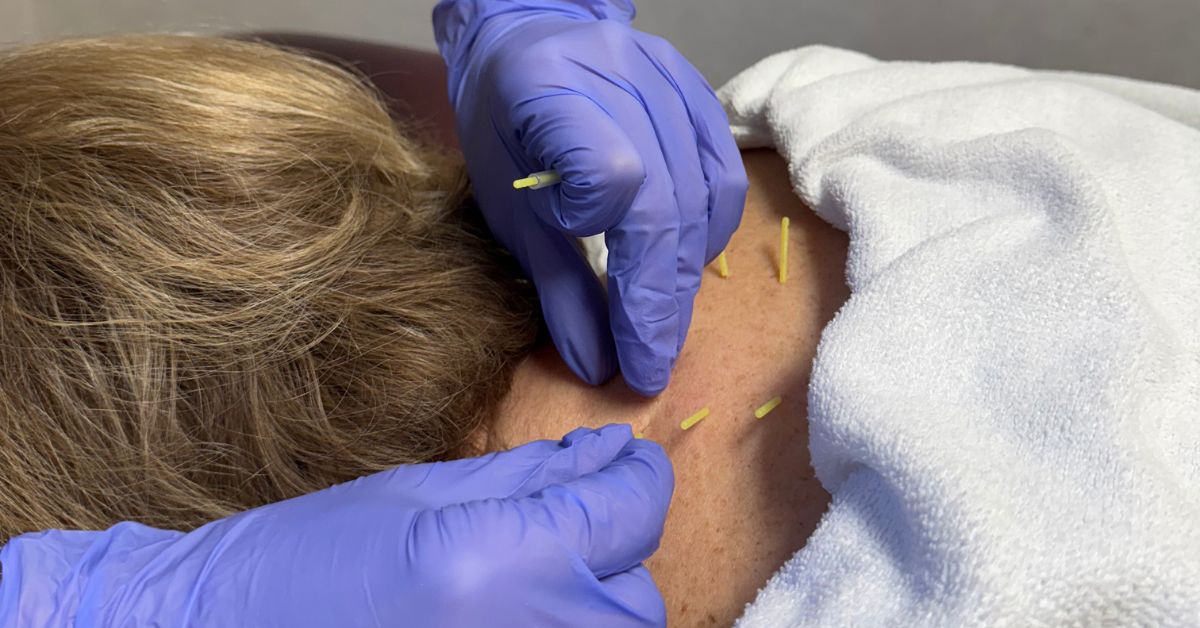 Emily, a Carolina Physical Therapy clinician at the Lexington clinic, performing dry needling on a patient’s neck to relieve muscle tension and pain.