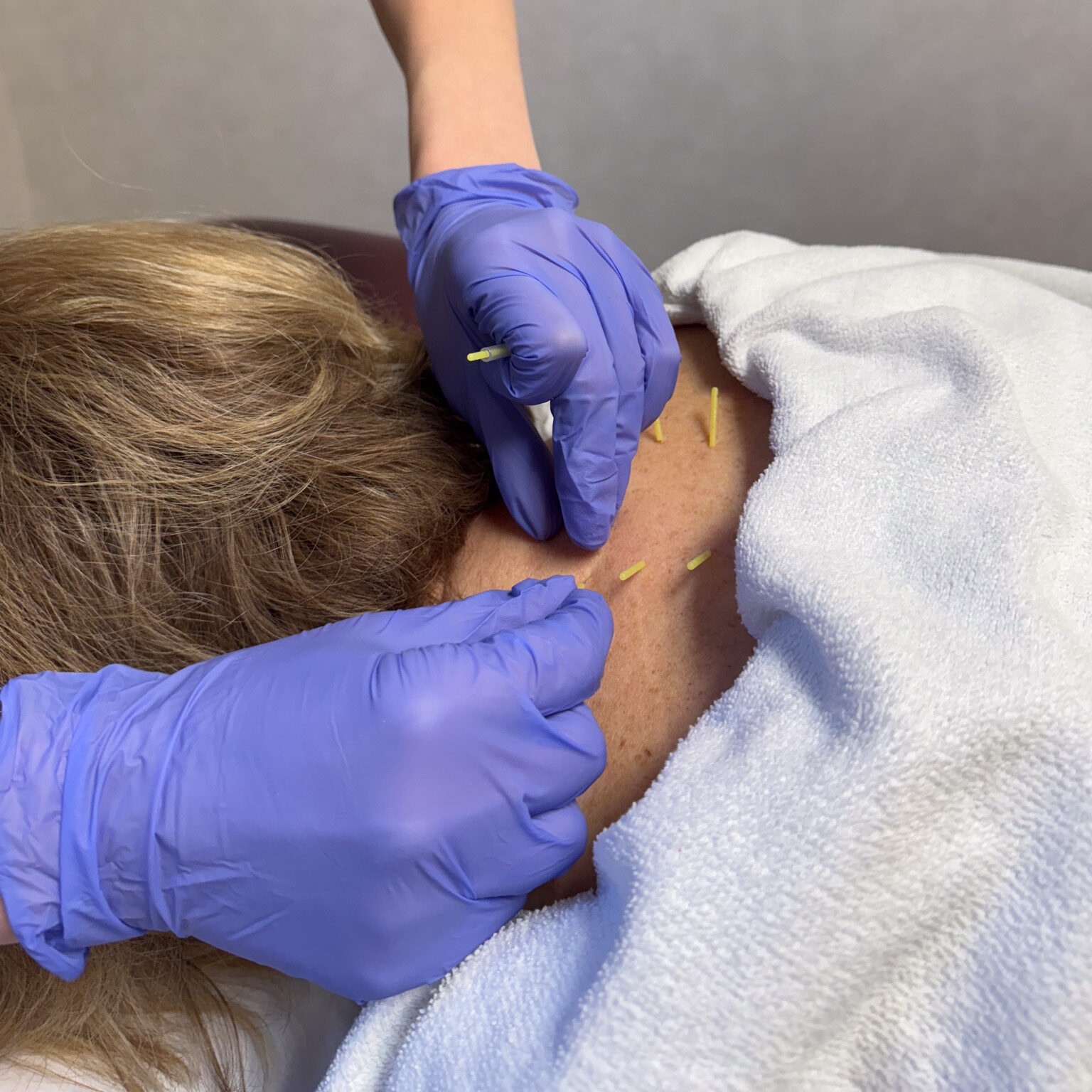 IMG_2635 Carolina Physical therapy Dry Needling